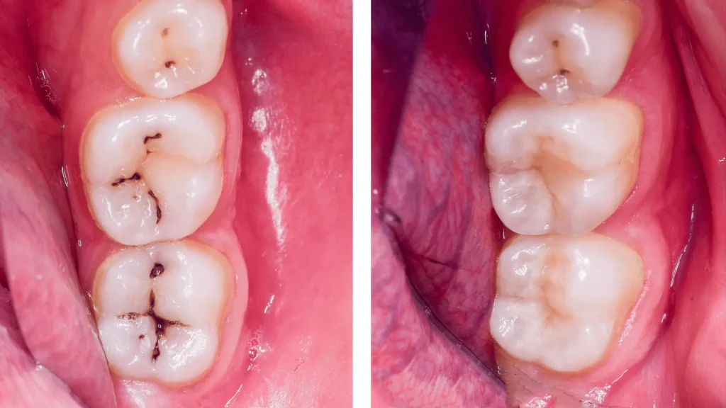 Лечение на зъбен кариес показва резултатът преди и след