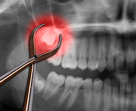 Хирургична стоматология - екстракция на постоянни и временни зъби