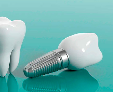Поставяне на зъбни импланти